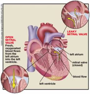mitral_valve_prolapse